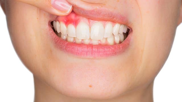 what to do about gum swelling 2